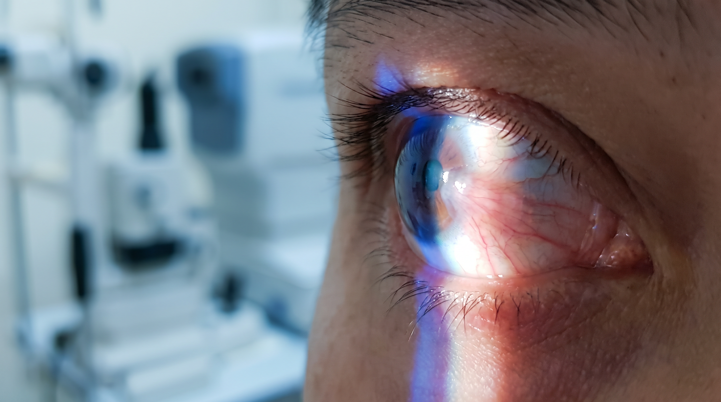 Cirurgia de Pterígio com transplante conjuntival — Visare Hospital de Olhos