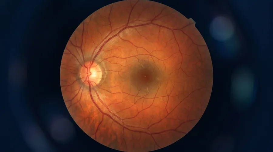 Vitrectomia — tratamento de moscas volantes e doenças do vítreo — Visare Hospital de Olhos