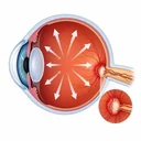 Glaucoma